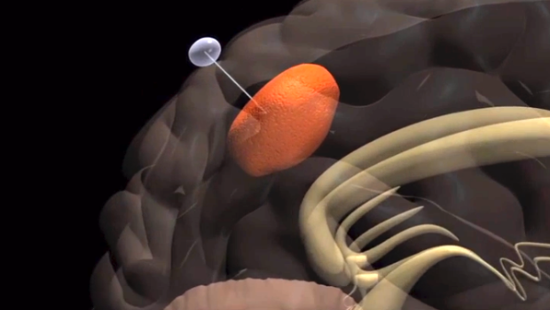 Study: Nanofibers partially “move” brain tumors to accessible locations