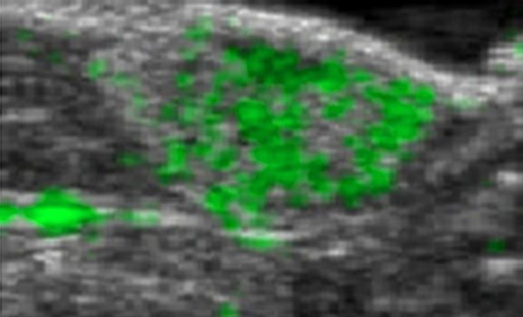 Ultrasound combined with contrasting agent for radiation-free tumor detection