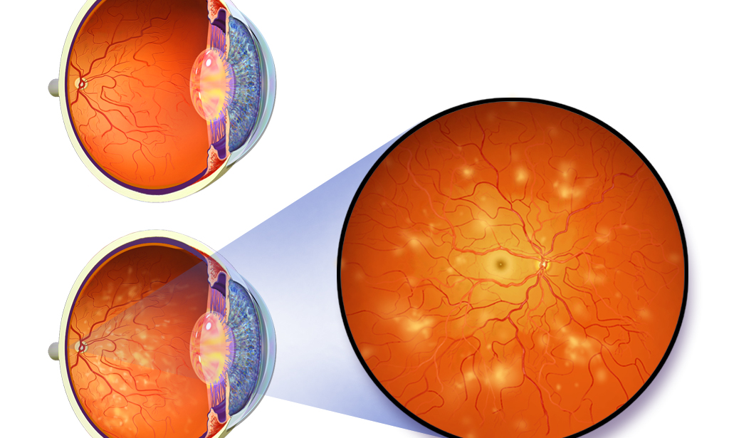 Гипертензионная ангиопатия сетчатки что это. Гипотоническая ангиопатия сетчатки глаз. Диабетическая ретинопатия сетчатки глаза.