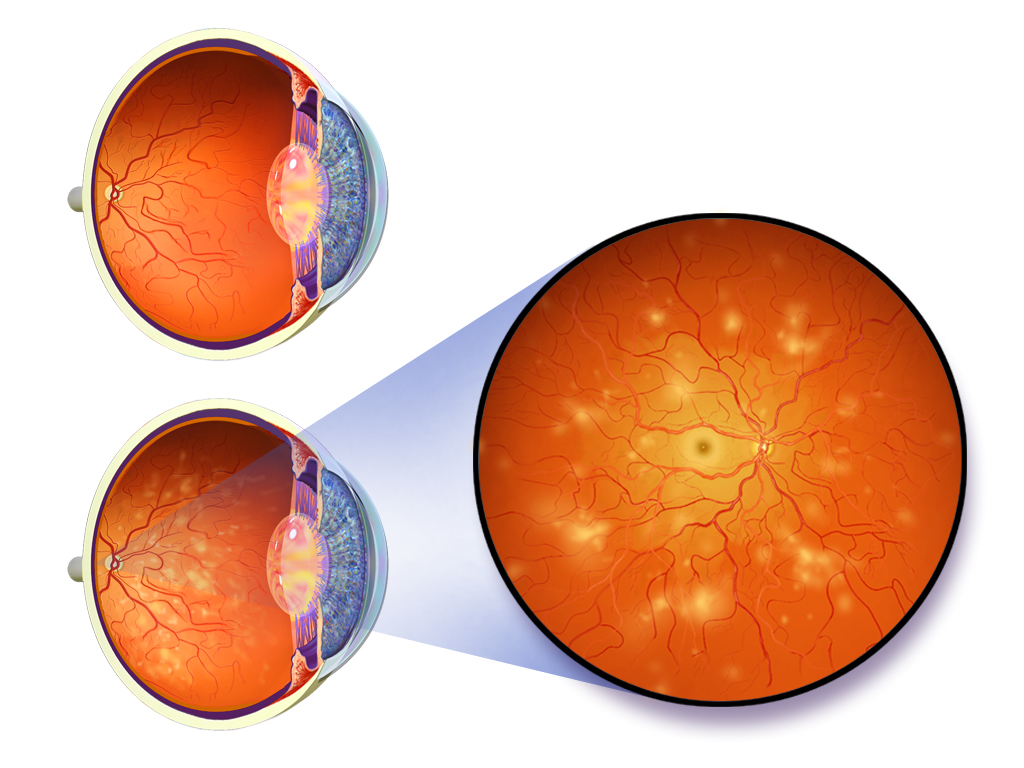 Adaptive optics detect diabetes eye damage early