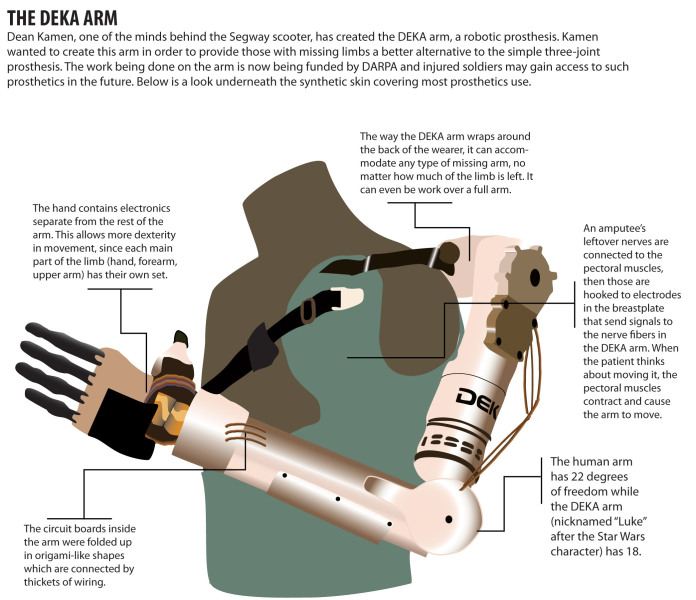 Prosthetic arm moves after muscle contraction detected