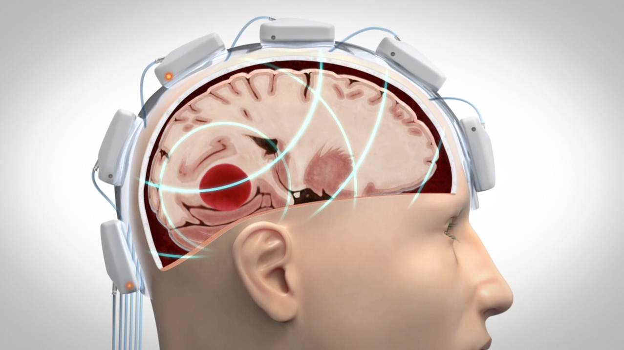 Microwave helmet for early stroke diagnosis, treatment