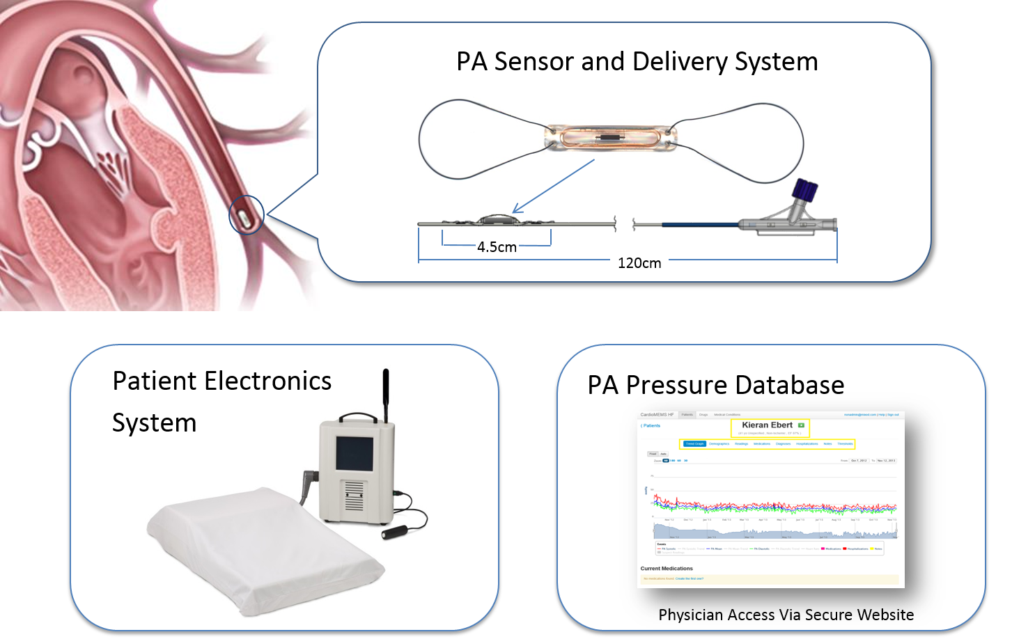 Implanted sensor continously monitors CHF