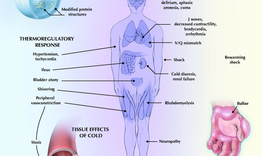 Body’s cold sensor could treat hypothermia, heart failure – ApplySci