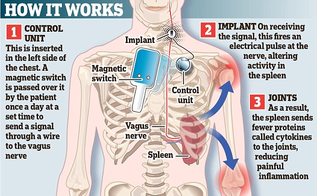 Implant stimulates vagus nerve, relieves arthritis pain