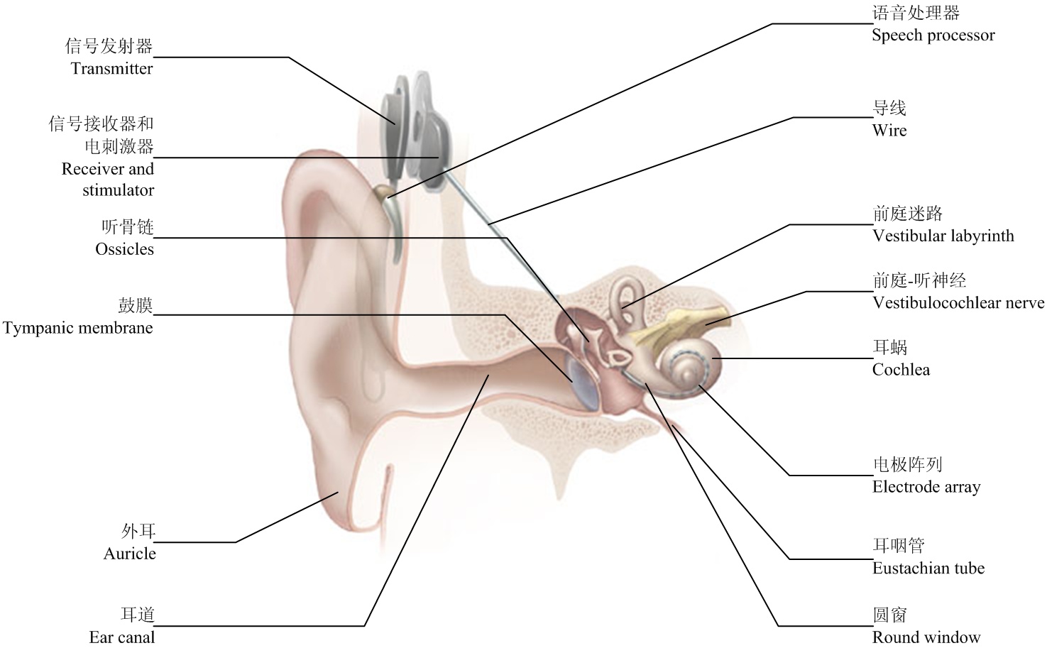 Cochlear implant could improve senior cognition, mood