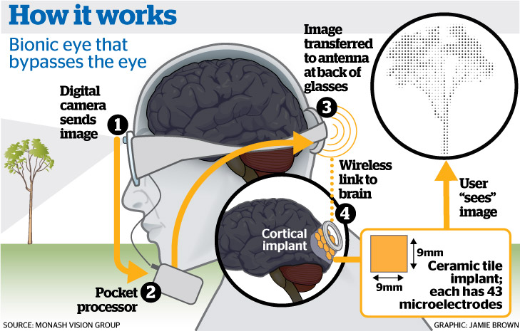 Wireless brain chip restores vision, bypasses eye