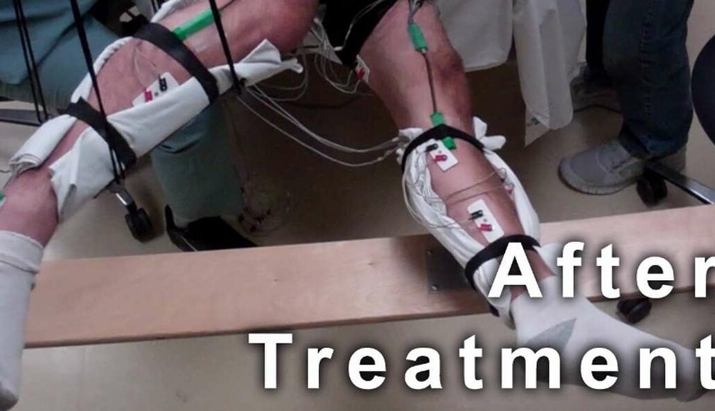 Paralyzed patients move legs with nonsurgical stimulation ApplySci