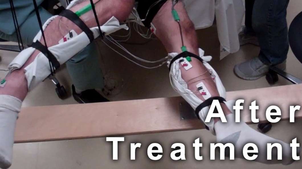 Paralyzed patients move legs with non-surgical stimulation