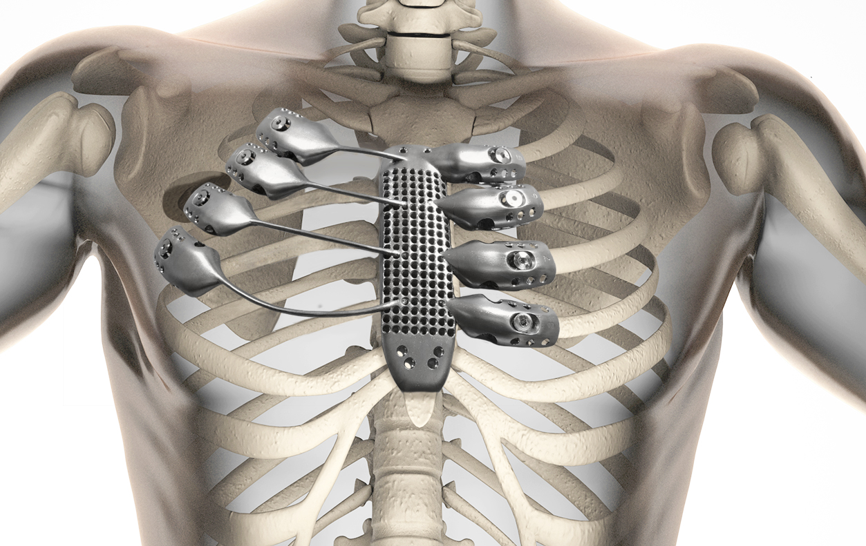 Cancer patient receives 3D printed rib cage