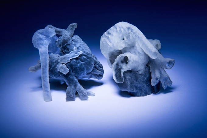 Faster, personalized, 3D printed heart models for surgery planning