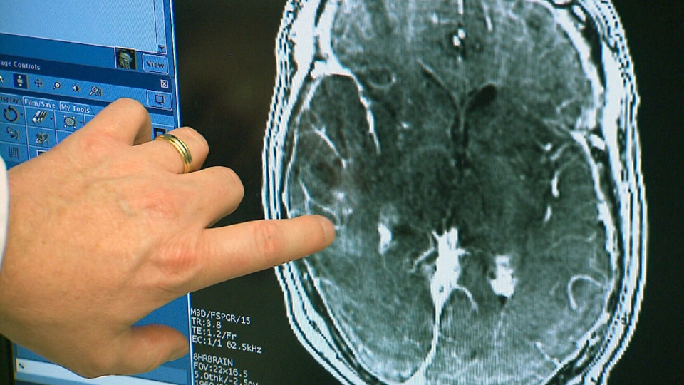 Ultrasound penetrates blood-brain barrier to treat brain tumor