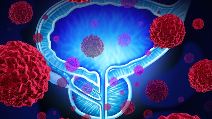 Sensor + algorithm detect prostate cancer in urine