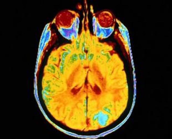 Amyloid PET Imaging for dementia diagnosis, treatment, research
