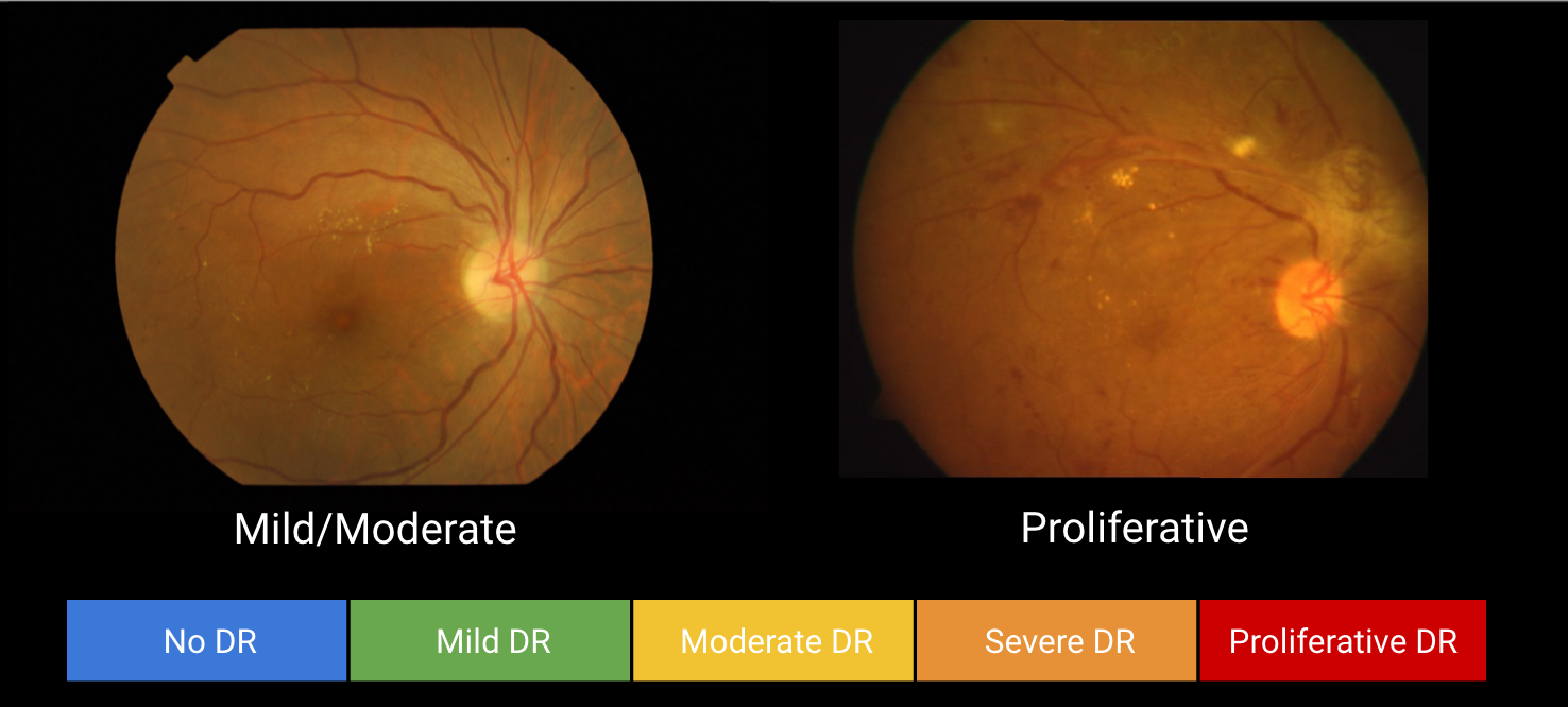 Diabetic retinopathy-detecting algorithm for remote diagnosis