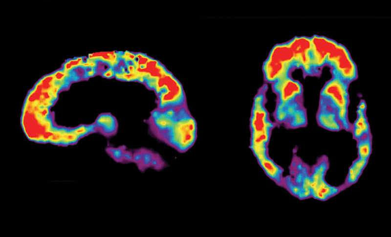 Alzheimer’s diagnosis disputed in up to 50% of PET study subjects
