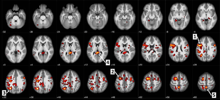 AI used to study brain blood flow ties to Schizophrenia