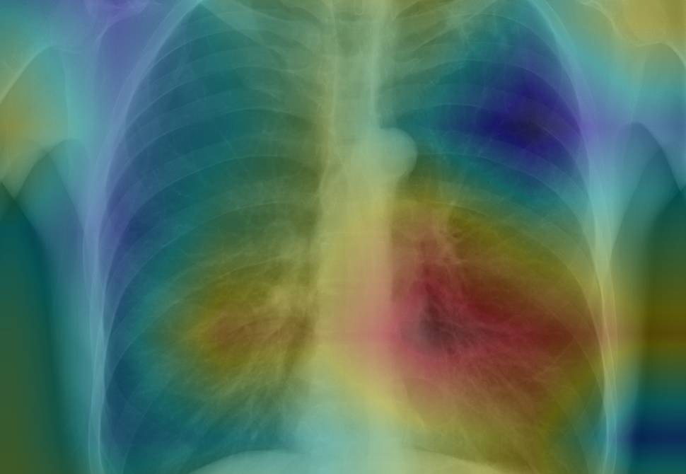 AI detects pneumonia from chest X-rays