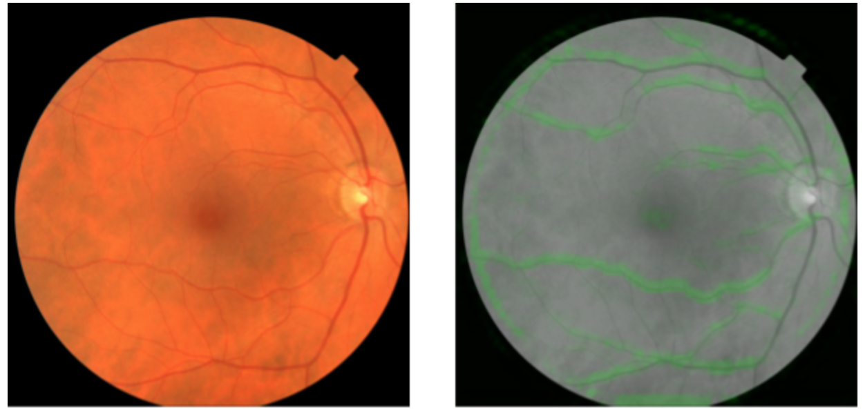 Heart attack, stroke, predicted via retinal images