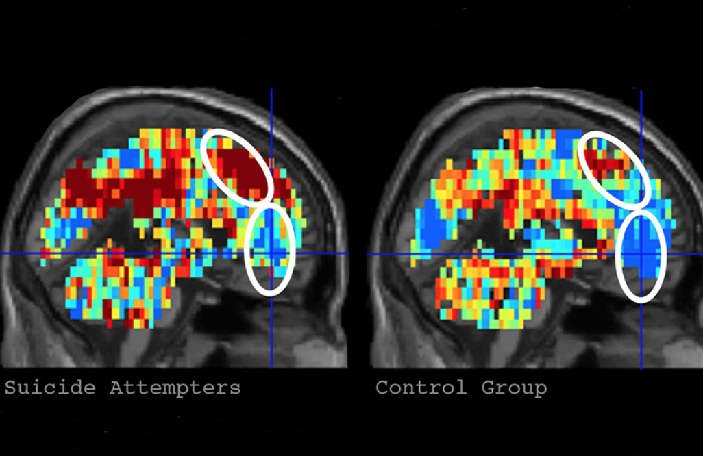 Brain imaging to detect suicidal thoughts