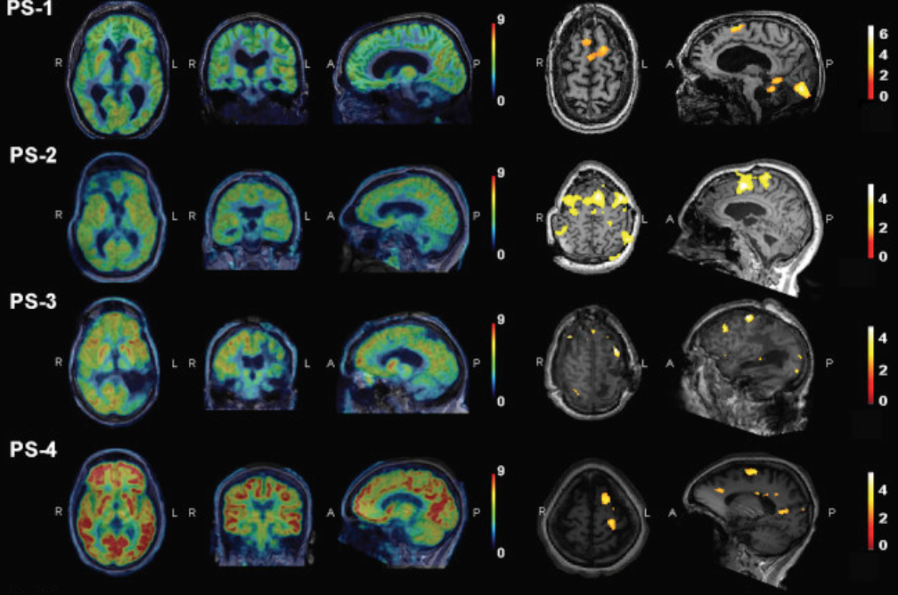 EEG identifies cognitive motor dissociation