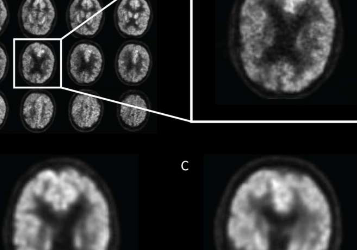 Alzheimer’s detected by AI 6 years before diagnosis