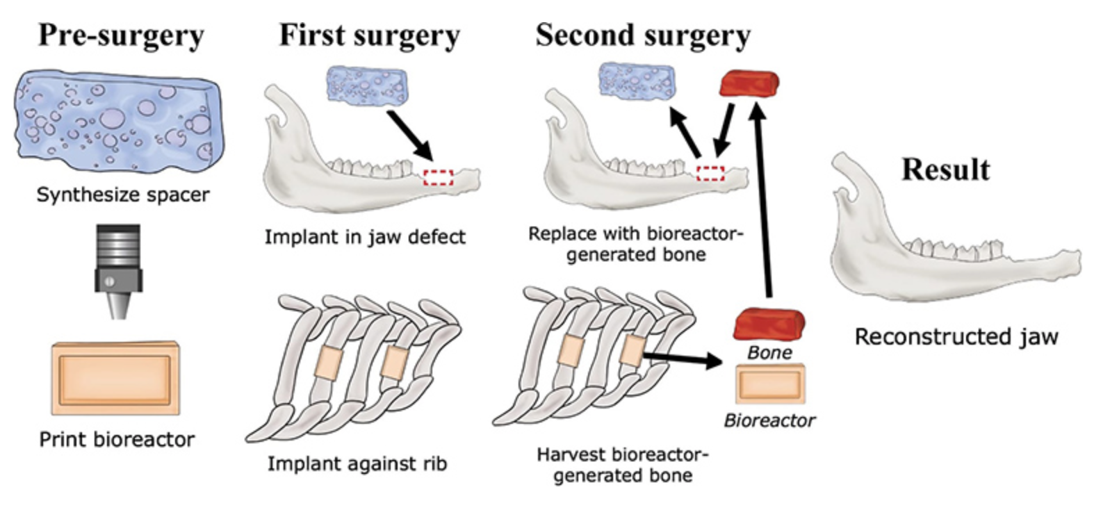 3D printed bioreactor-grown bone for craniofacial surgery