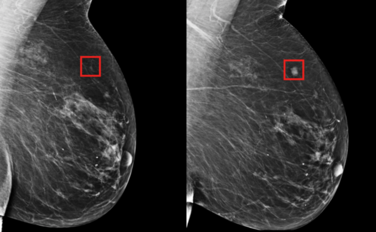 Deep learning mammography model detects breast cancer up to five years in advance