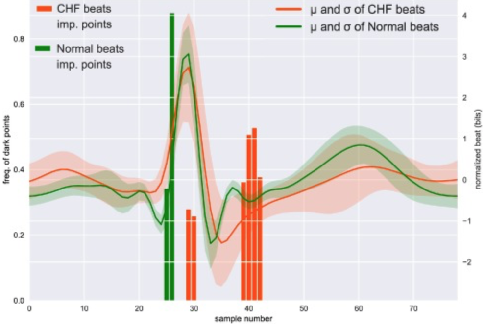 AI detects CHF through analysis of one heartbeat