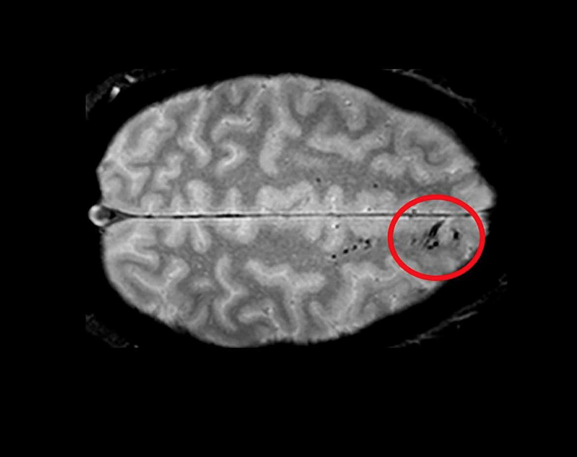MRI-detected microbleeds may help determine disability after brain injury