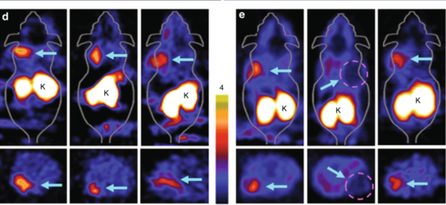 PET scan tracer detects both cancer and lung disease