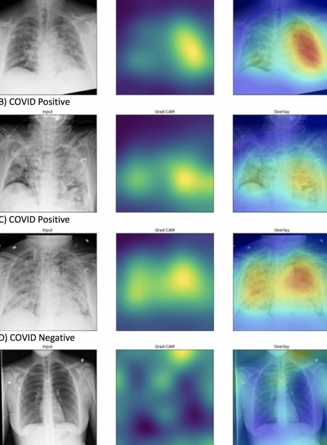 AI detects COVID in chest x rays