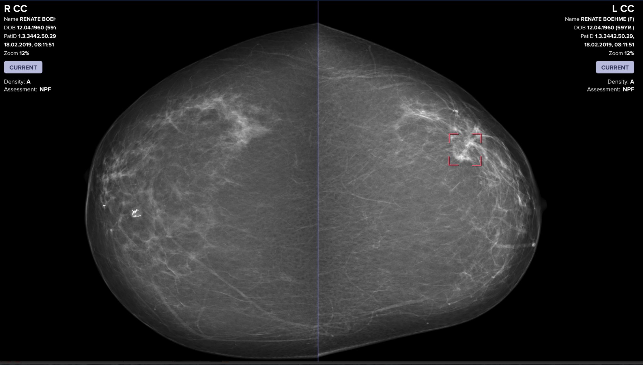 AI catches breast cancer earlier, more often than traditional screening alone