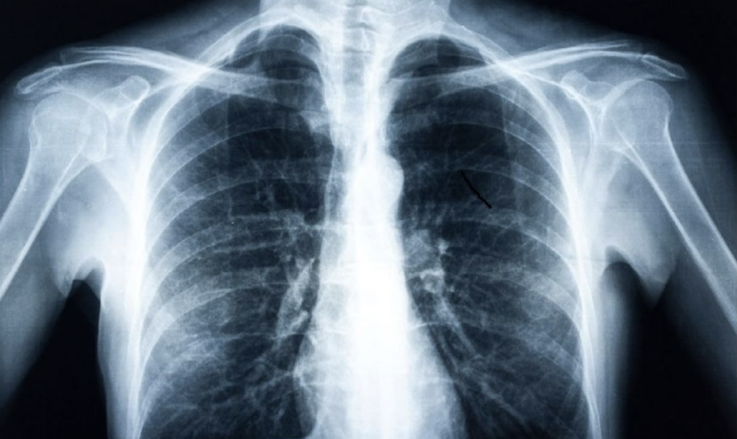 AI detects diabetes from fatty tissue in chest x rays – ApplySci