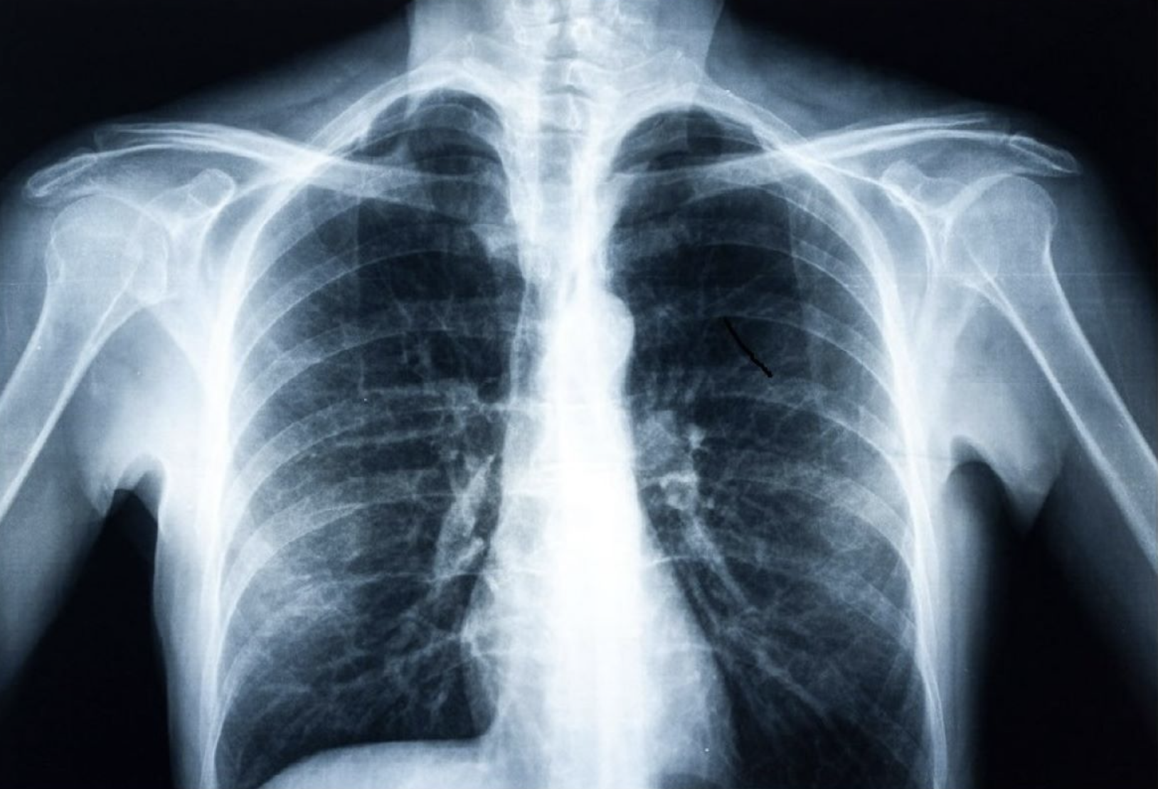 AI detects diabetes from fatty tissue in chest x rays